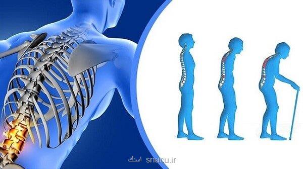 چطور میتوان از پوکی استخوان جلوگیری کرد؟