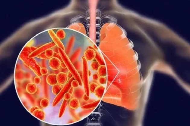 پنومونی همچنان بزرگ ترین قاتل عفونی جهان